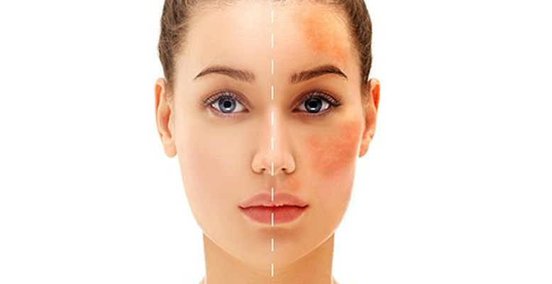 hiperpigmentasi kulit penyebab dan cara mengatasinya