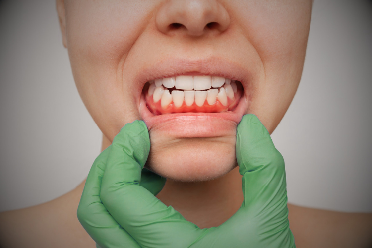 penyakit gusi perburuk diabetes dan sakit jantung