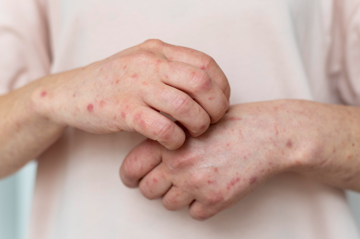 scabies_atau_kudis