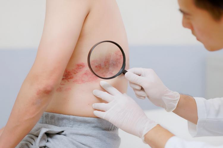 bahaya herpes zoster