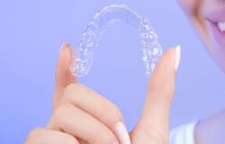 clear_aligner_behel_gigi