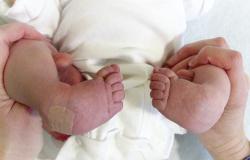 penanganan kaki bengkok pada bayi