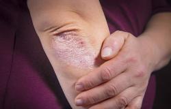 kekurangan vitamin d picu keparahan psoriasis
