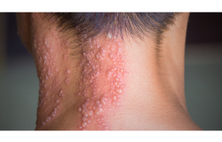 mitos dan fakta cacar api