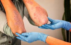 mitos psoriasis dari menular hingga disebabkan jamur